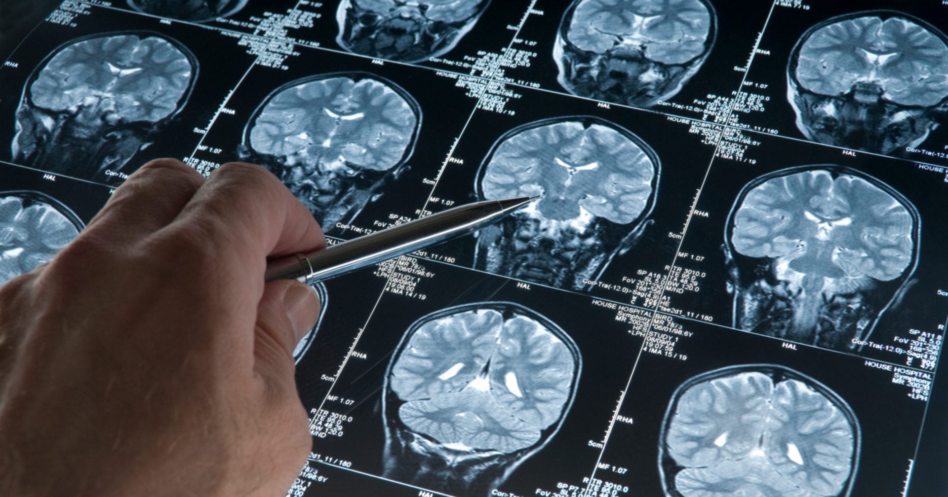 FDA aprueba una nueva herramienta diagnóstica para el alzhéimer